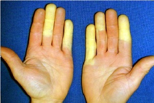 vibration-induced-white-finger-disease.png
