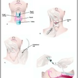 Tracheal intubation algorithm 